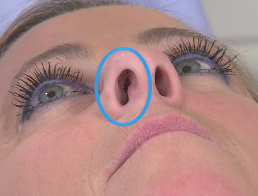 deviated septum nostrils